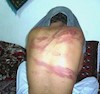 آثار شکنجه بر بدن یکی از دستگیر شدگان زاهدان