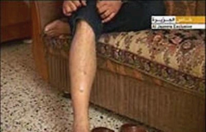 آثار شکنجه بر بدن یکی از زندانیان زندانهای مخفی مالکی- آرشیو