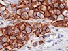 سلولهای سرطانی