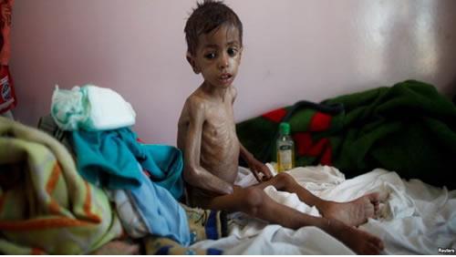 قربانيان وبا در يمن رو به افزايش است